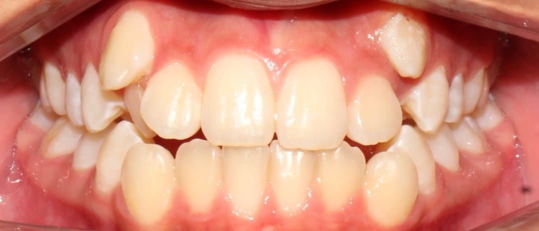 Antes tratamiento de ortodoncia