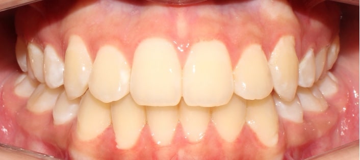 Después tratamiento de ortodoncia