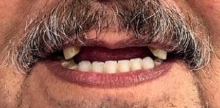 paciente antes implantes dentales cd juarez