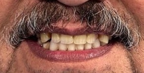 paciente después implantes dentales cd juarez