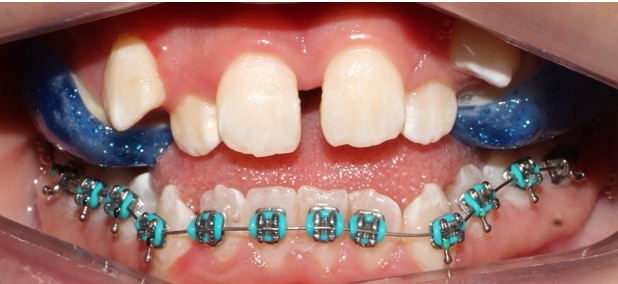 pacientes antes de tratamiento de ortodoncia cd juarez