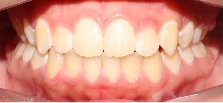 pacientes después de tratamiento de ortodoncia cd juarez